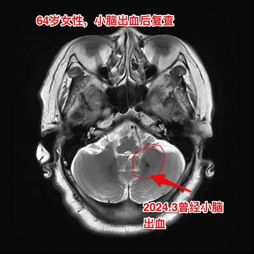 脑血管病很常见，预防胜于治疗。缺血性脑血管病很常见，致死致残，危害性极...