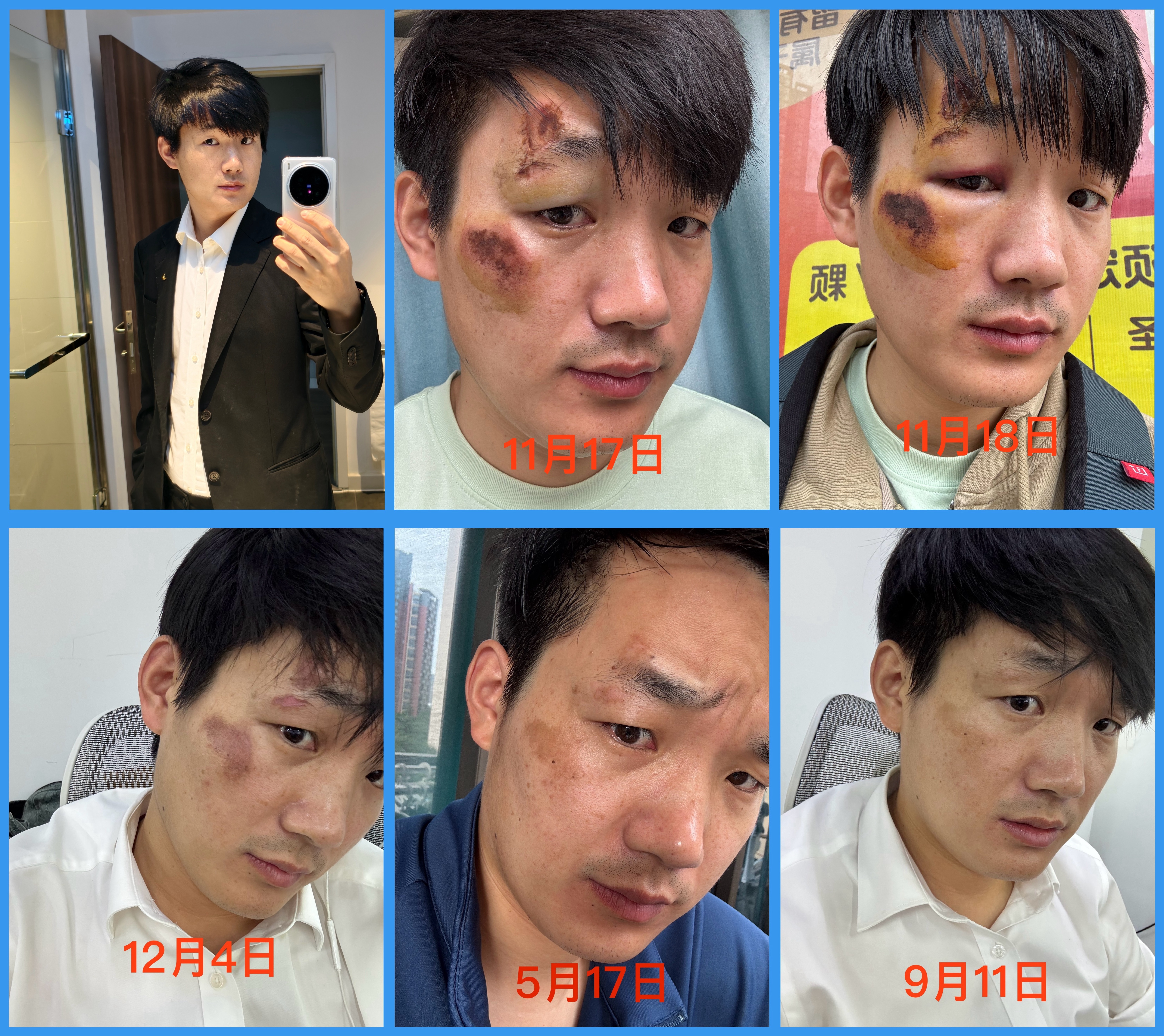 再说一遍，我脸上不是胎记，是骑滑板车摔了，导致脸上擦伤表皮，留下的黑色素沉淀，现