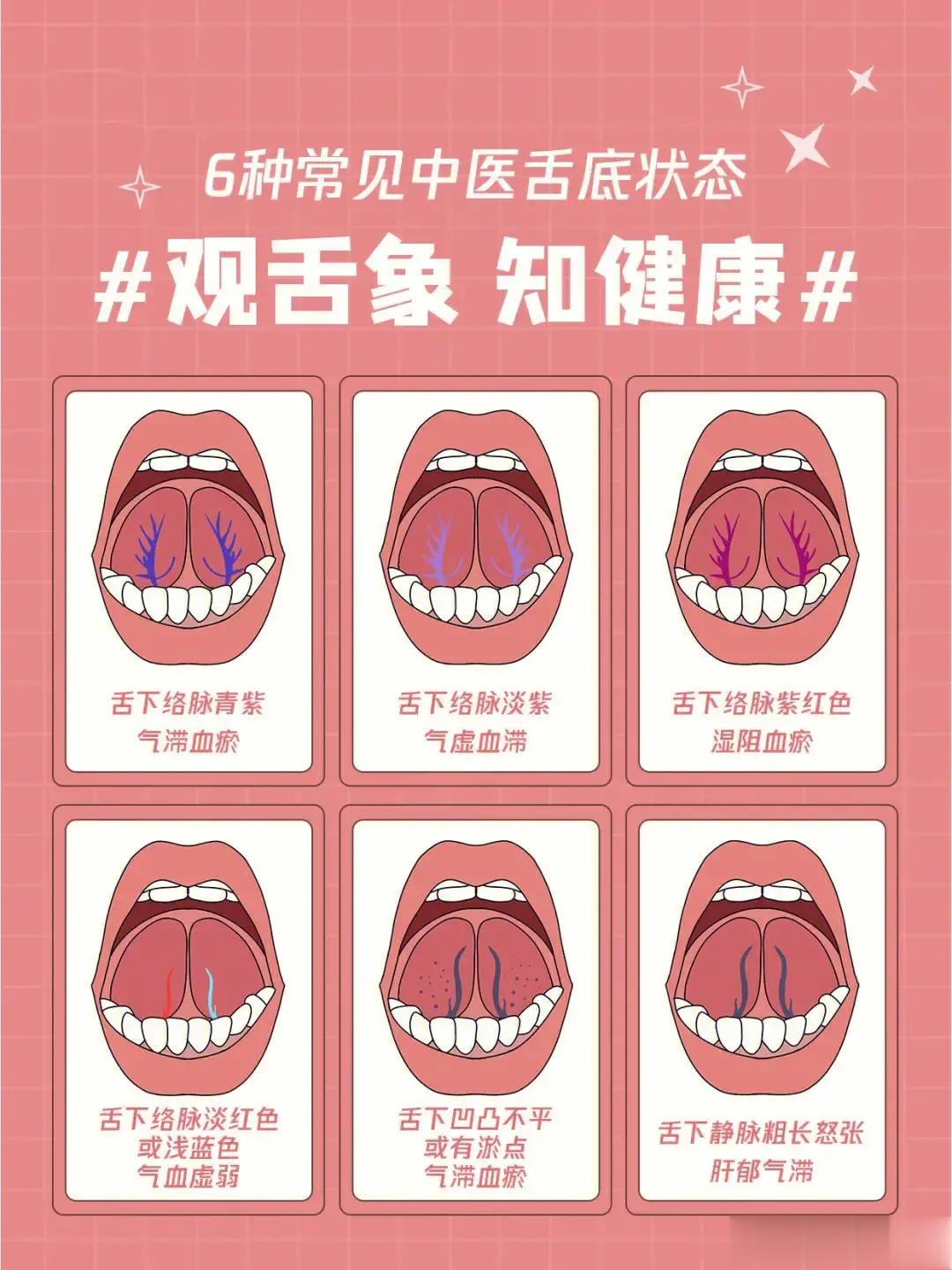 观舌像，知健康。看看是属于哪一种？正常的舌像：淡红舌，薄白苔。舌体柔软，活动自如