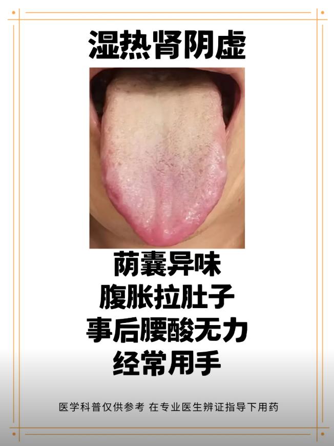 中医舌诊：脾肾双虚，肝肾阴虚，湿热肾阴虚！分别有哪些症状！