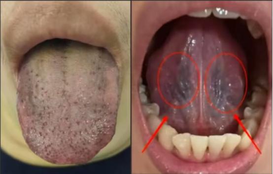 说过多少遍了！紫暗舌别乱活血！桃仁红花乱用，瘀滞只会更重！

很多人一看舌头紫暗