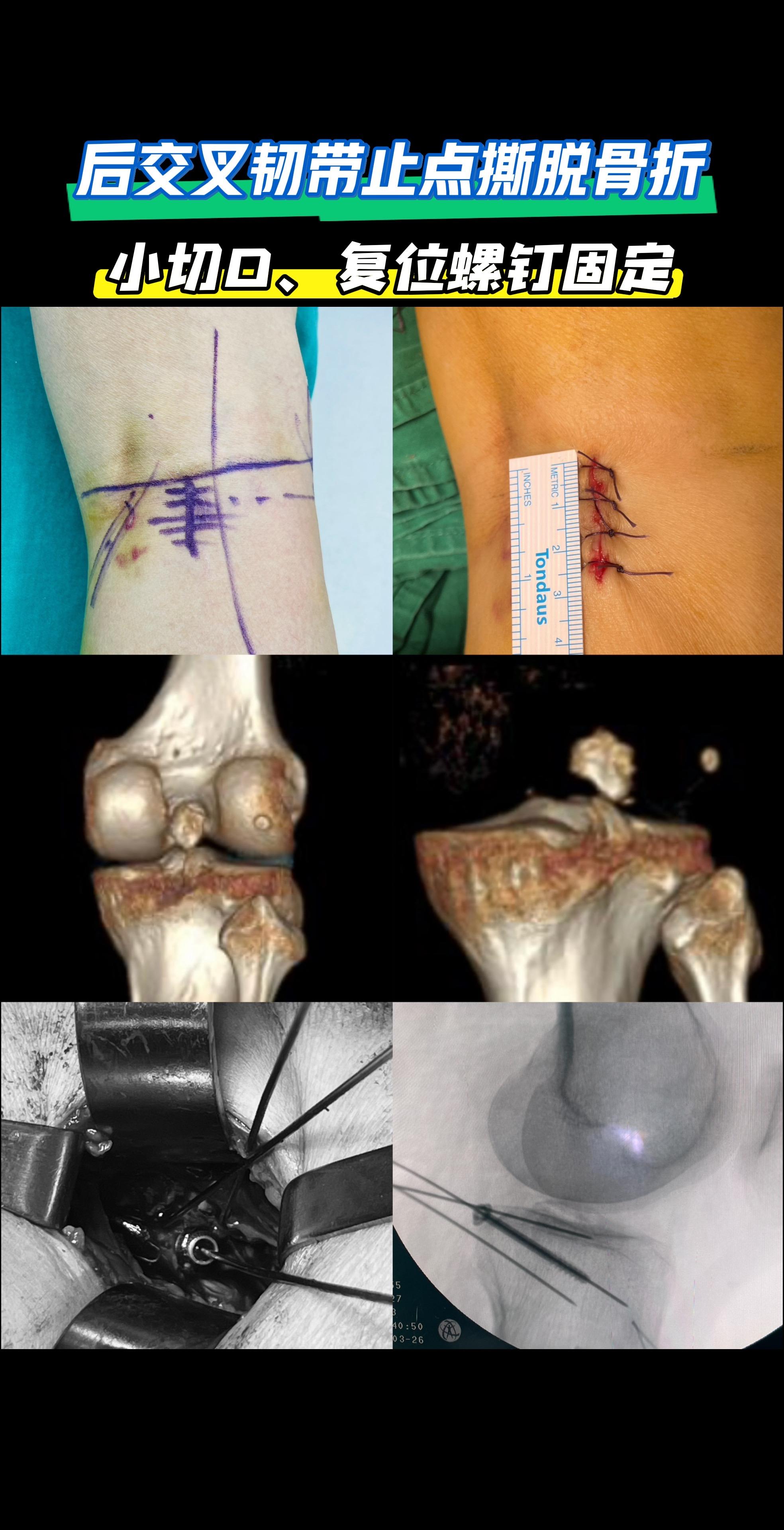 后交叉韧带止点撕脱骨折。侧卧位，小切口复位螺钉固定
