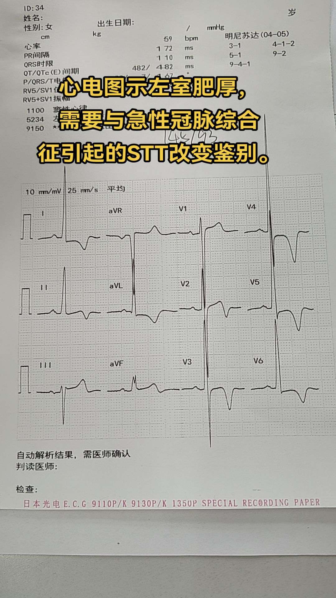 心电图左室肥厚。心电图左室肥厚：一系列导联都会发生波形改变。