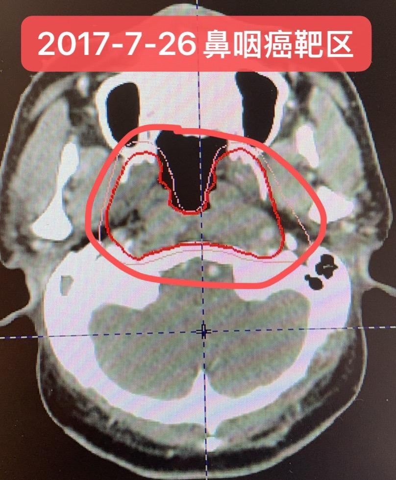 局晚期鼻咽癌治疗后的随访：持续8年无复发。2017年体检发现颈部包块...