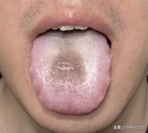 吓懵了！癌症患者的黑苔舌象，竟藏着脾胃衰败的信号

从医三十余载，我见过无数疑难