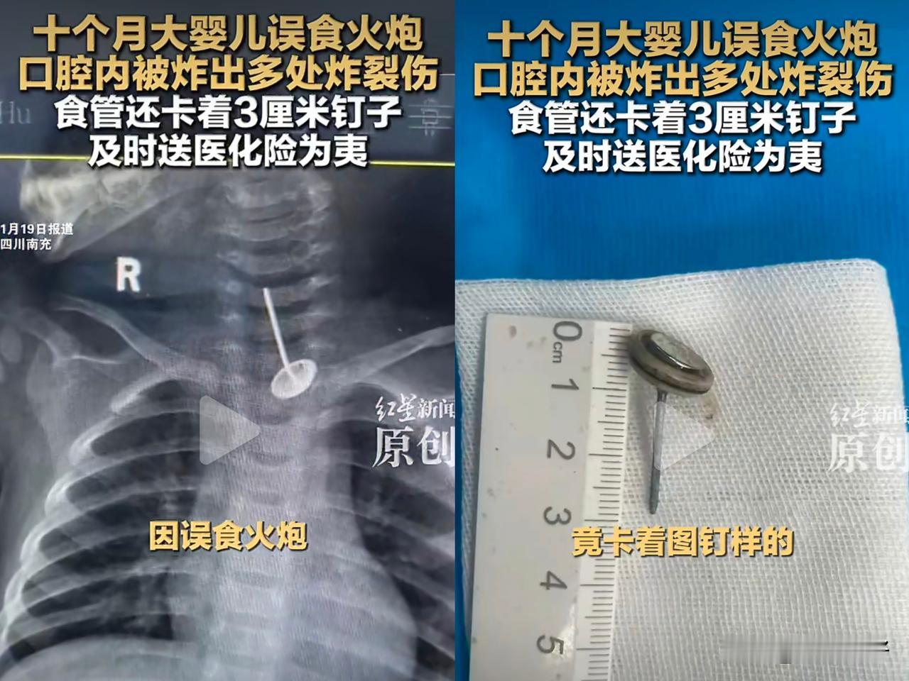 2026年1月14日晚，四川南充一名10个月大的婴儿因误食鞭炮导致口腔炸裂伤，送