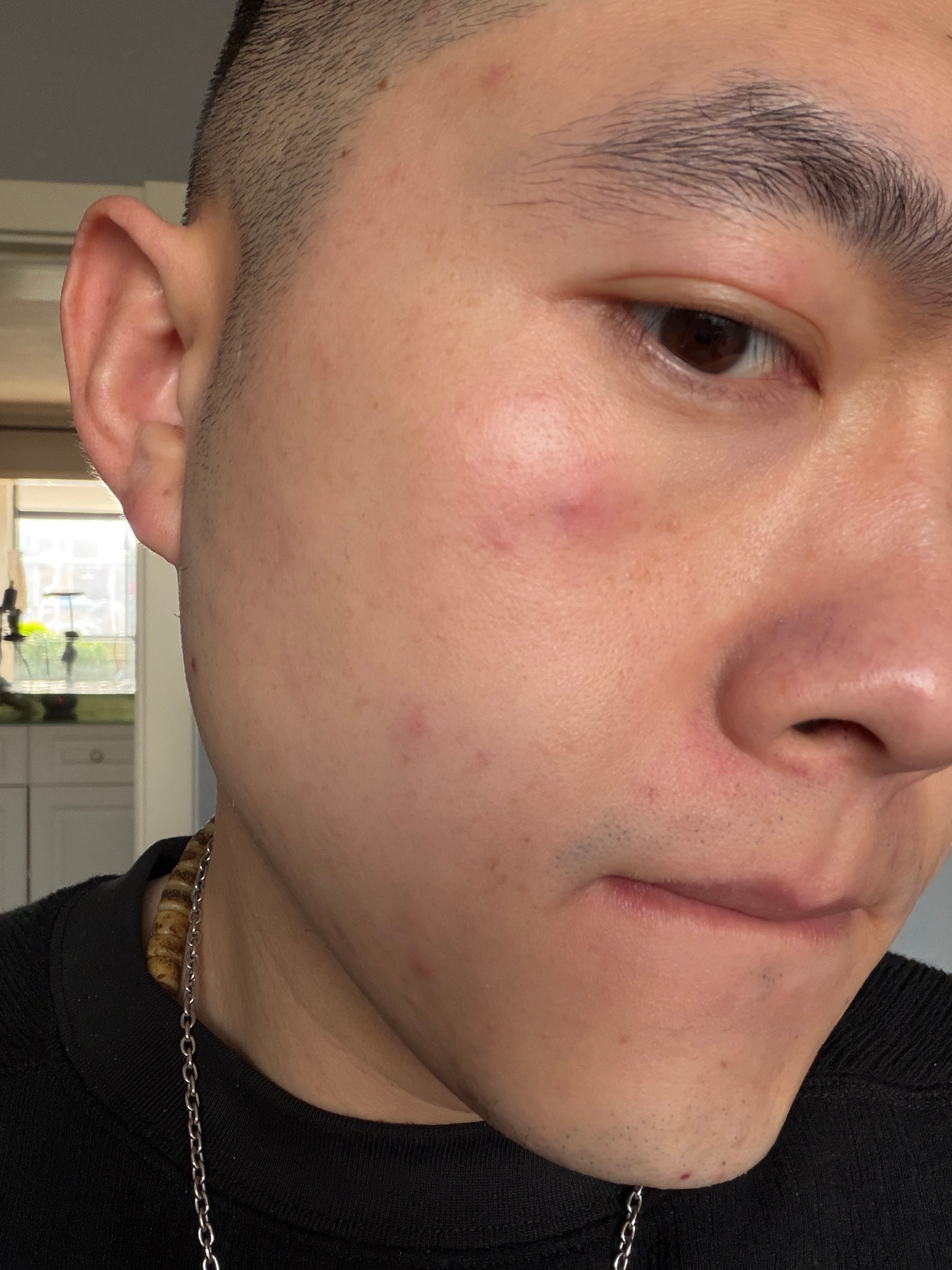 晚上还要参加晚宴呢，这特么突然爆痘了.....最近熬夜多，也没有怎么运动，忙完这