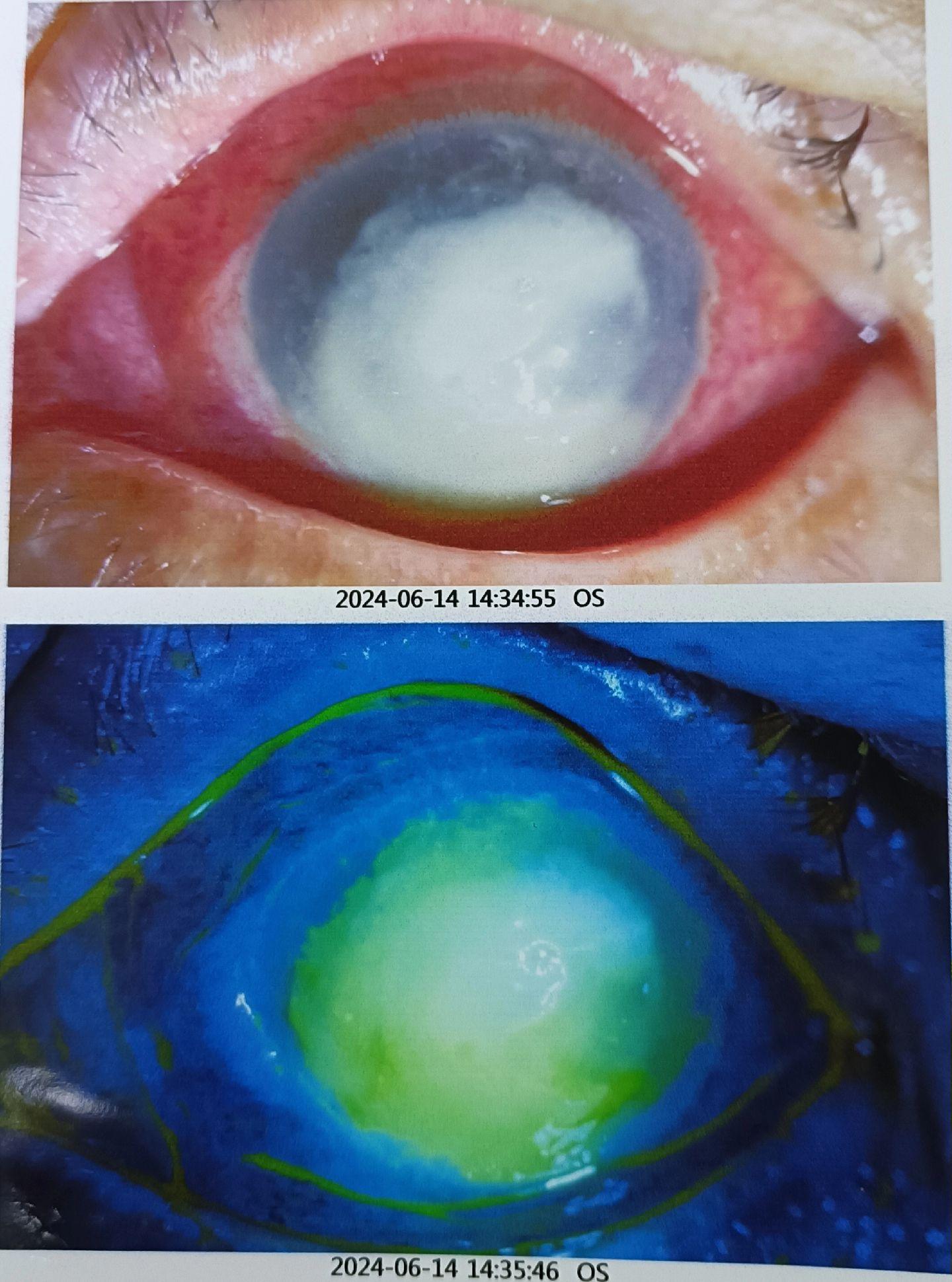 农忙时节，请爱护我们的眼睛，这是一个被玉米叶刷到眼睛的老年人，真菌性角...
