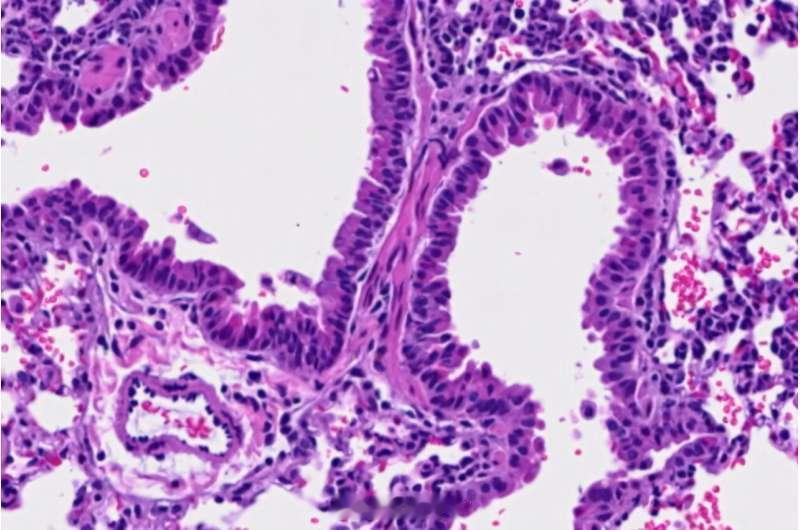 精氨酸可能帮助免疫系统对抗肿瘤和病毒感染 这篇MedicalXpress报道介绍