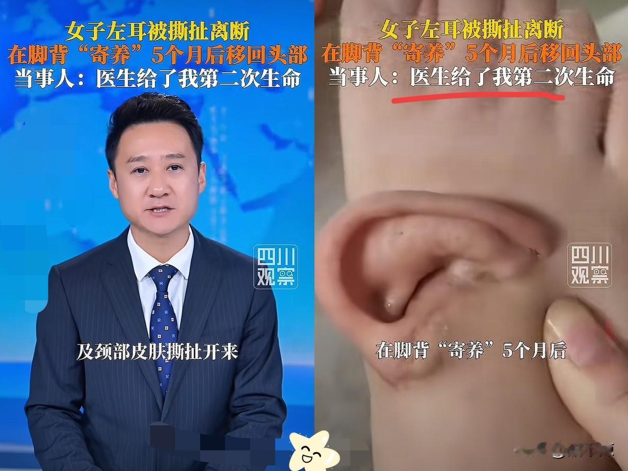 天下之大无奇不有！
山东一女子因为意外，导致左耳断裂，送医后，医生竟想出把耳朵“