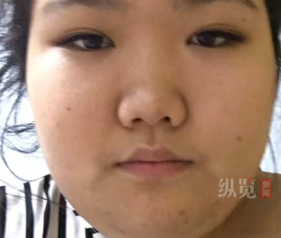 27岁女教师从326斤减至170斤热点观点 从个人层面来看，这一成果堪称励志典范