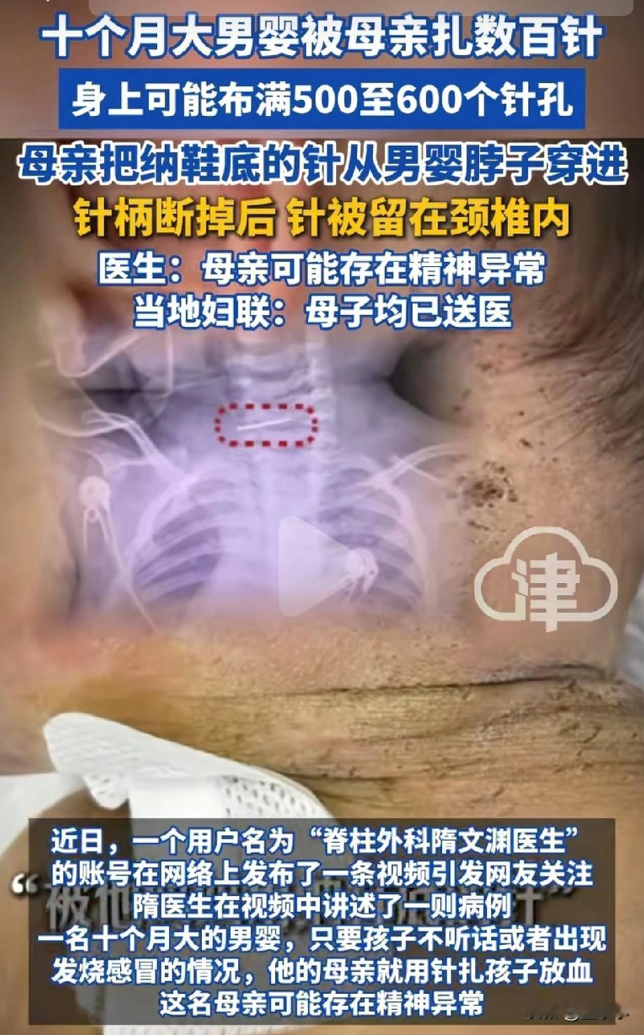 “真的太揪心了！”10个月大的婴儿身上被扎了上百个针孔，母亲用纳鞋底的针从婴儿脖