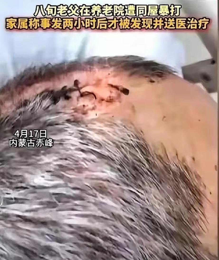 必须严惩！”内蒙古赤峰，女子将父亲送到养老院，几天后去接，只见父亲裤子直接裂开到