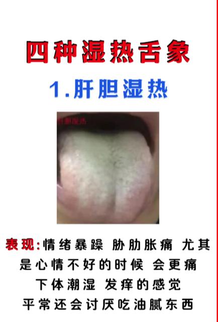 4 种湿热舌象对照，一看便知是哪类湿热