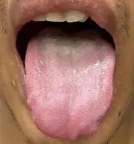 患者天天用手，再看这舌头，就知道身体虚的不成样子了！

患者主诉：房事力不从心、