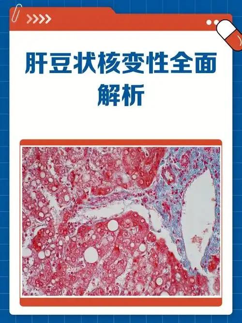 肝豆状核变性‌
是一种常染色体隐性遗传的铜代谢障碍疾病，主要因ATP7B基因突变