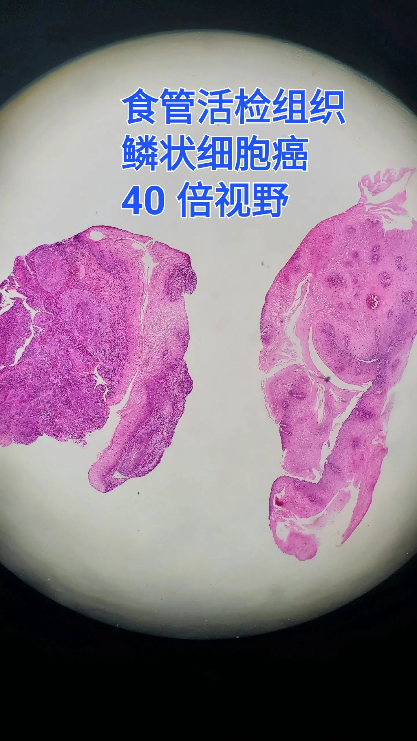 食管癌 显微镜下的世界