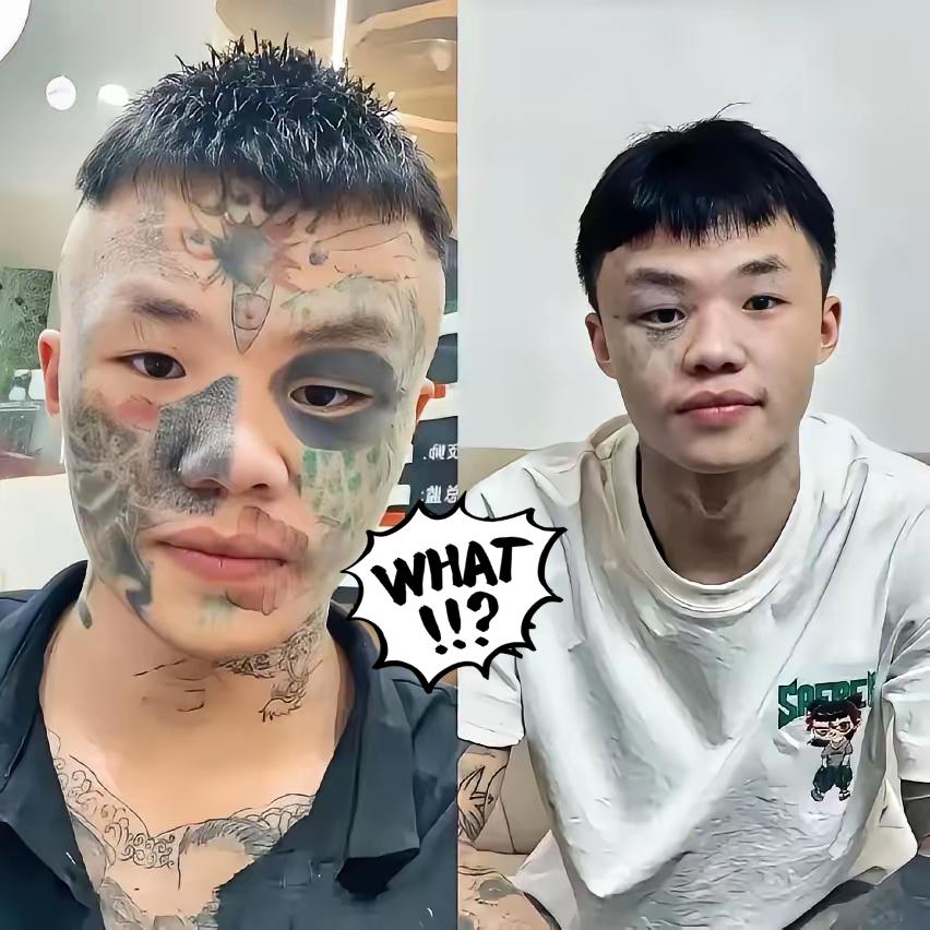 广东男孩夏朝勇这三次激光洗纹身，疼的哪是脸，是为13岁的“一时冲动”买单！

当