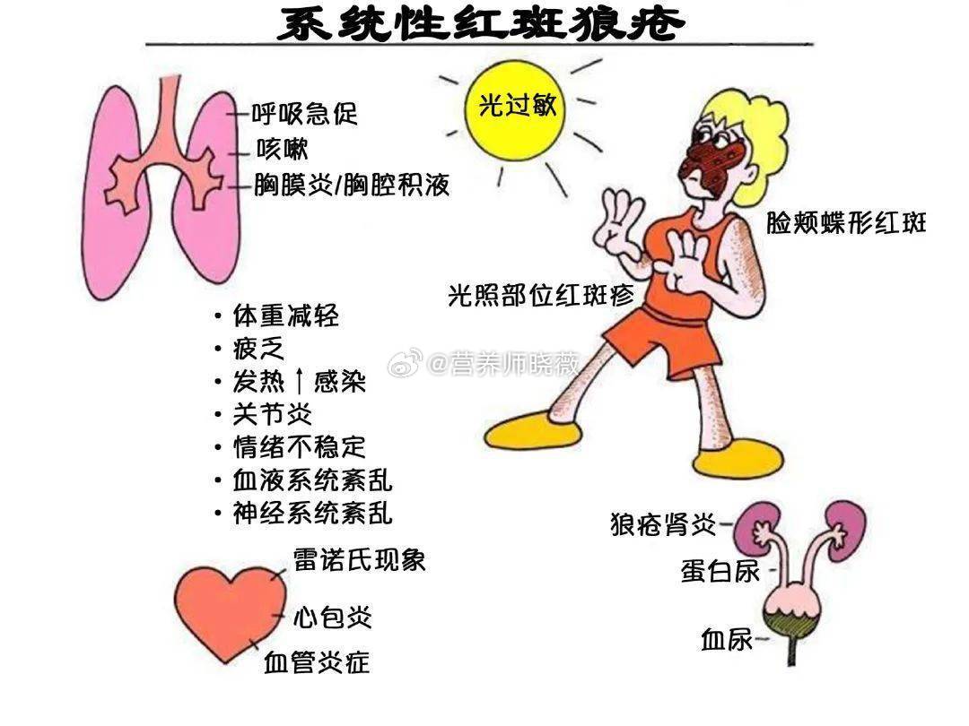 #红斑狼疮# 红斑狼疮是一种典型的自身免疫性结缔组织病。#我国红斑狼疮患病率世界