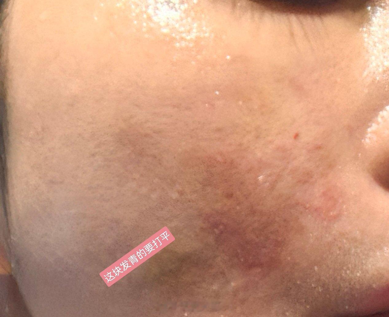 七月份的一次溶脂针后，我毁容了，给医院看了是再过段时间会恢复的，现在不要补，我都