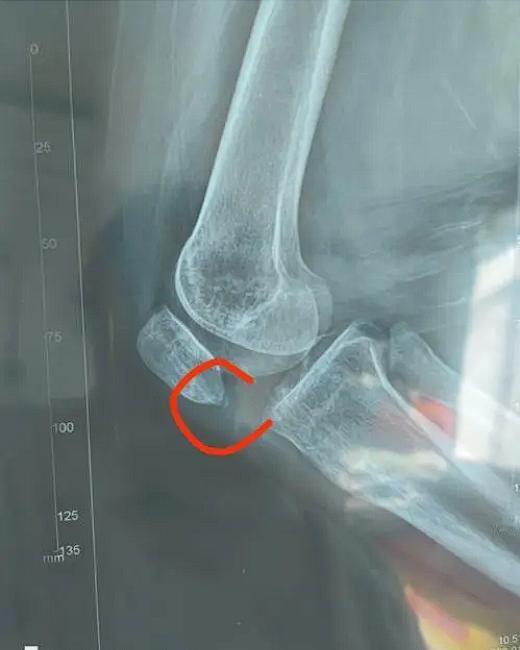 山东菏泽，一7岁男童因尿急在楼道里撒了泡尿，结果导致一名抱着婴儿的大妈滑倒，致髌