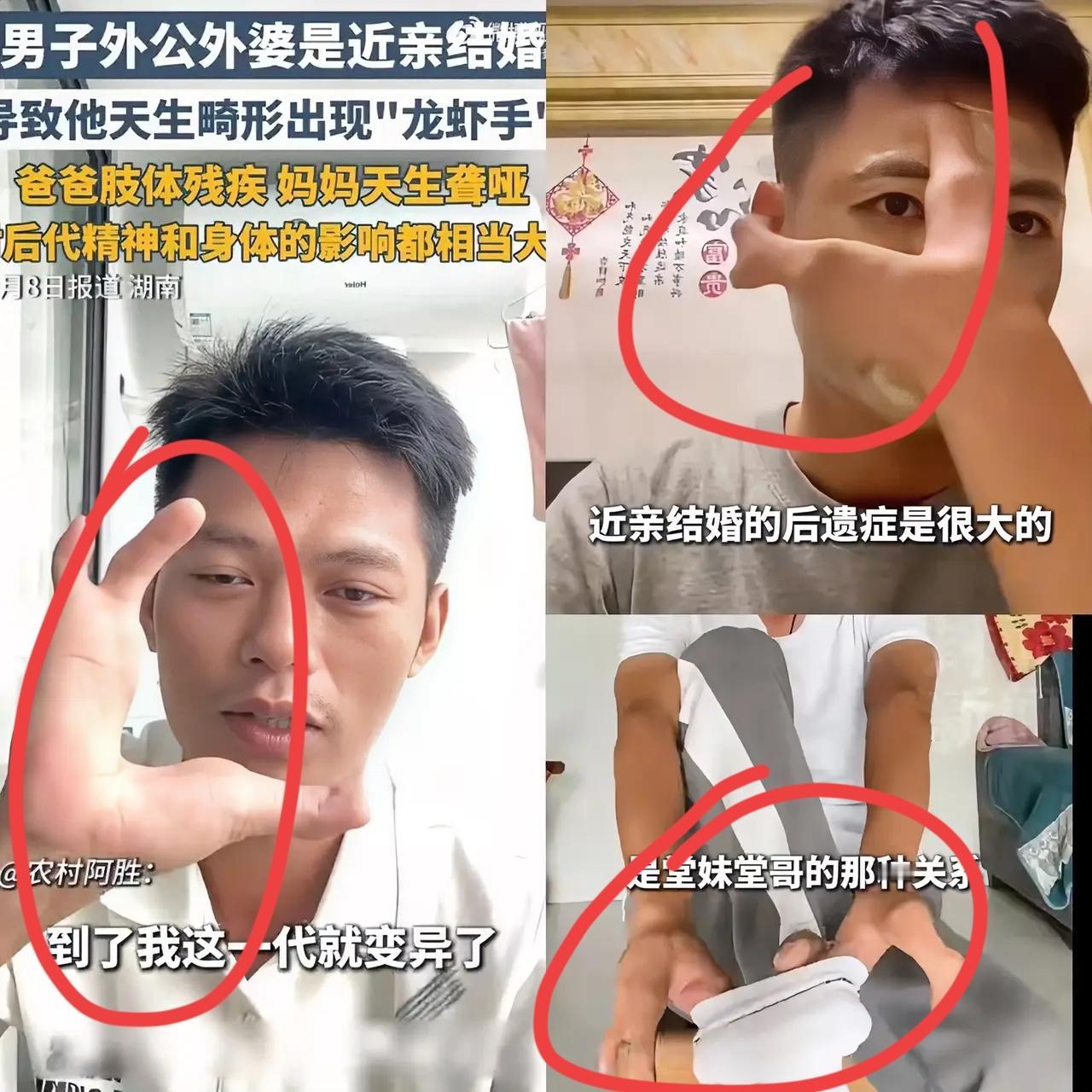 奉劝大家一句
真的要避免近亲结婚
湖南一90后的男子因外公外婆近亲结婚，导致了家