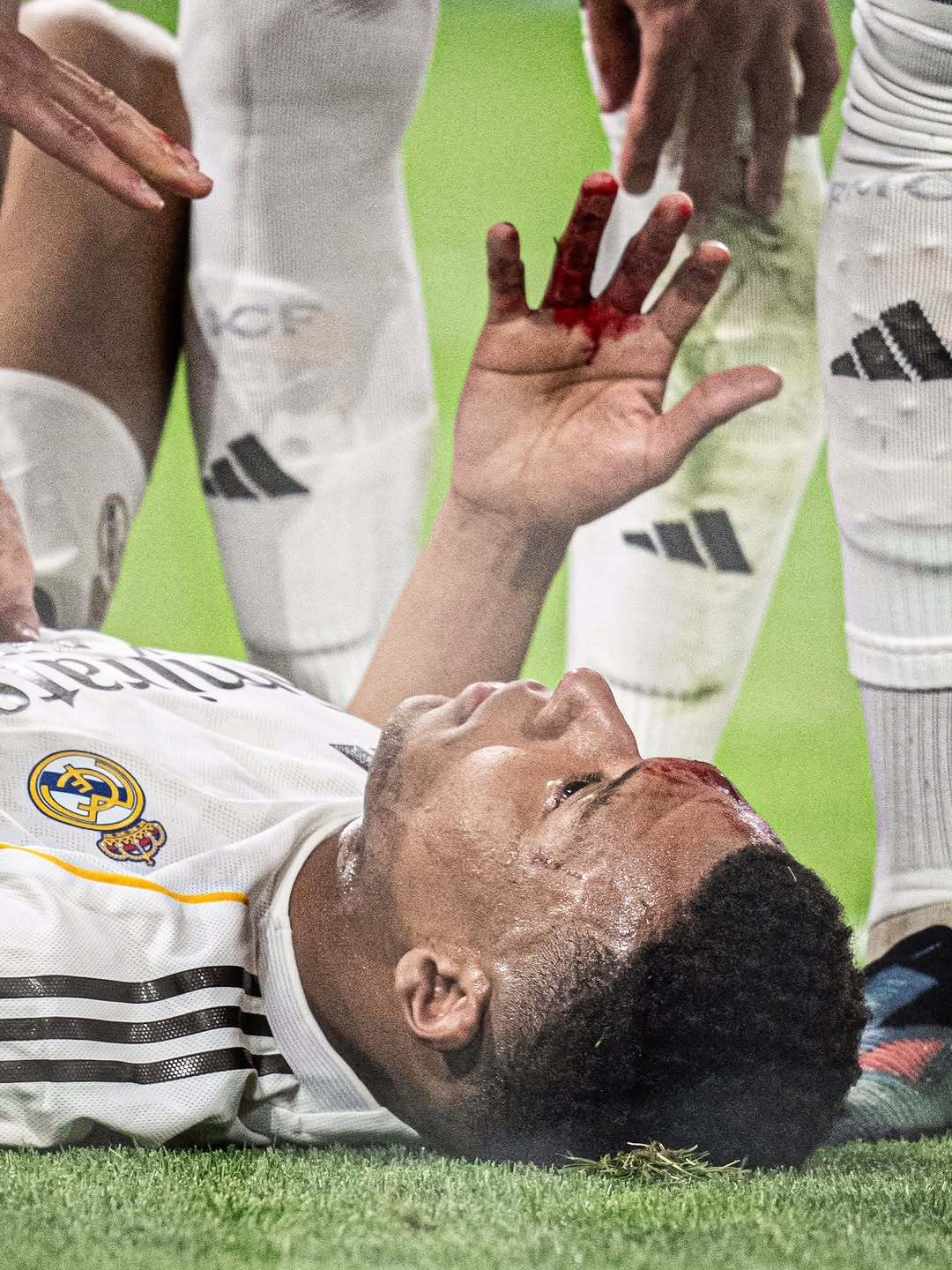 皇马皇马姆巴佩 姆巴佩血染的伤痕 