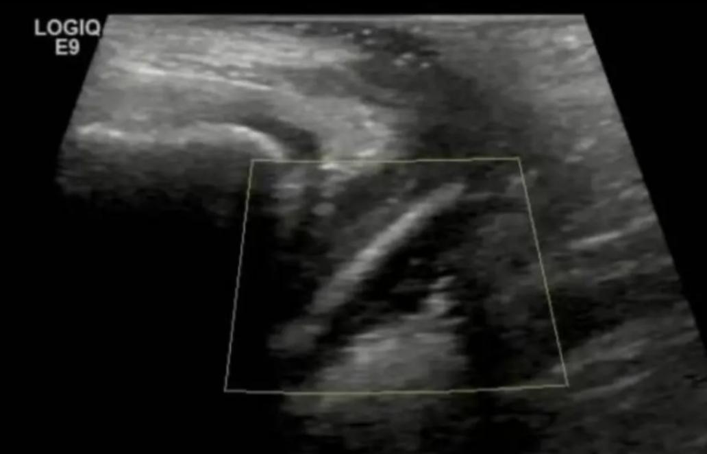 “万万没想到”！广东，一7岁女孩阴道炎反反复复，家长试过什么办法都不见好，无奈只