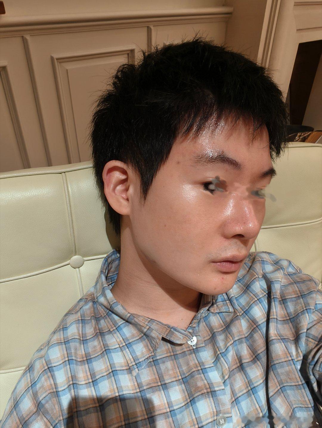 下颌角被婆婆用高跟鞋打了 