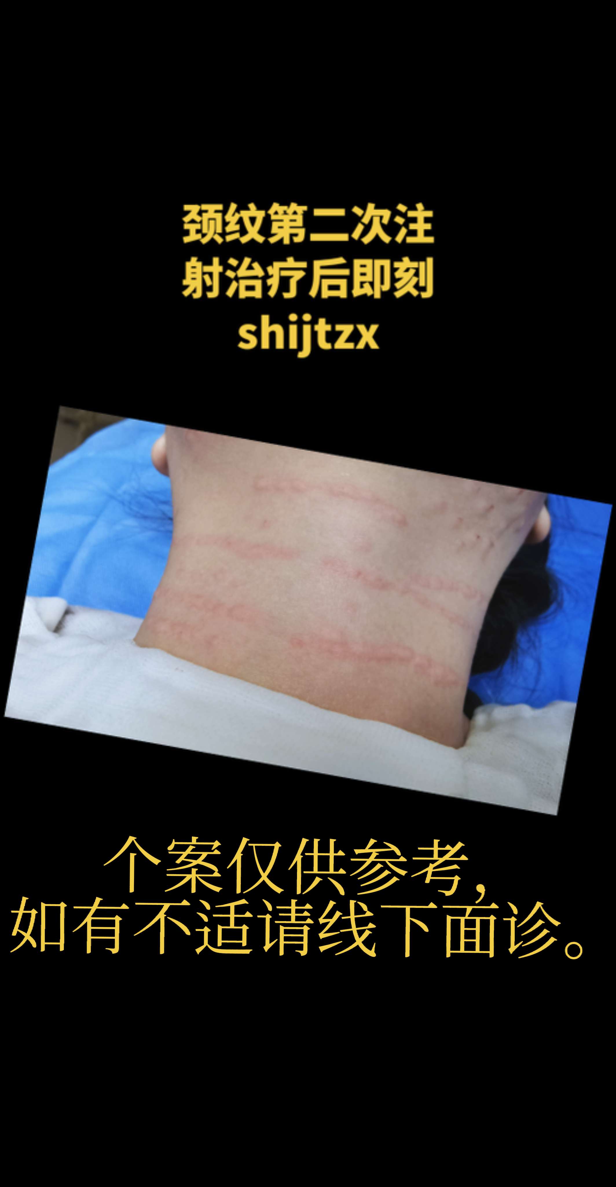 颈纹。颈纹注射一次后求美者自觉有效，又做第二次注射治疗。