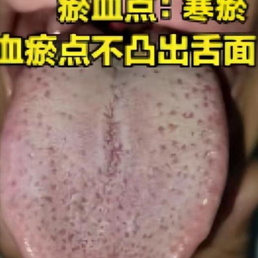 三种瘀证别搞混！寒瘀、热瘀、气滞血瘀，舌象一看就懂

1.寒瘀
舌象：舌下静脉粗