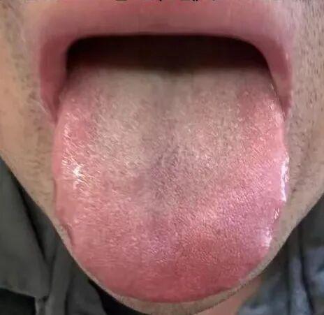 先清湿热，再补肾升阳，调理有方！
深度解析特殊舌象与调理策略
对于某些体质的人群