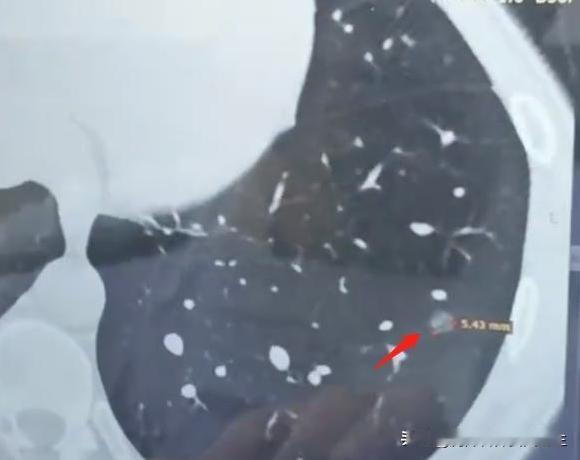 刚刚接诊了个年轻女性，在体检时发现左下肺有两个磨玻璃结节，吃了消炎药也没消掉，又