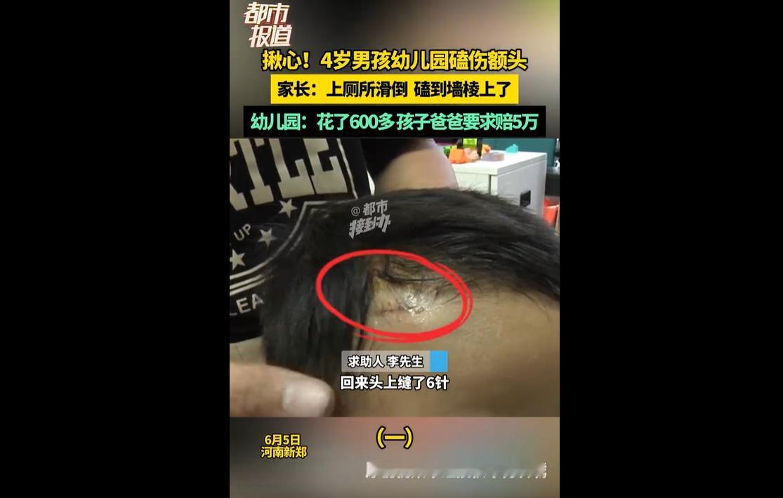 近日，河南一名4岁男童在幼儿园如厕时不慎滑倒，额头磕破受伤缝针。
孩子父亲李先生