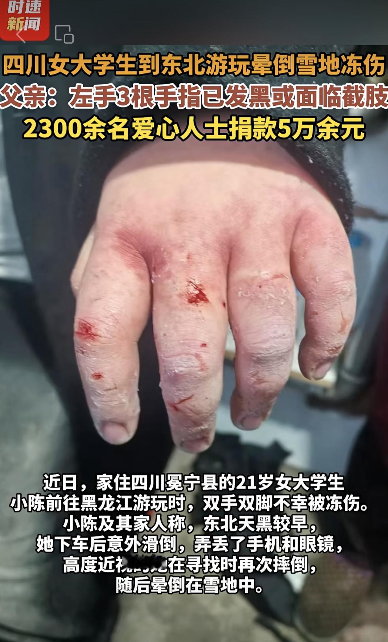 四川女大学生到东北游玩晕倒雪地冻伤，父亲：左手3根手指已发黑或面临截肢，2300