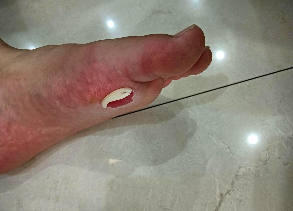 孩子踢球把脚后跟磨得露肉了，老师就在旁边看着。
体育课自由活动，不是放羊。
孩子