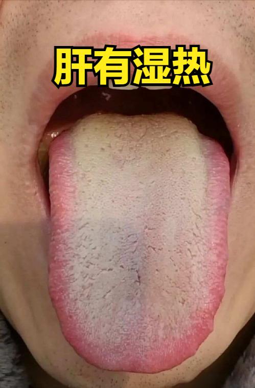 舌红苔黄腻 + 头油、大腿根瘙痒发臭、口干眼干痒，正是肝经湿热循经熏蒸、下注的典