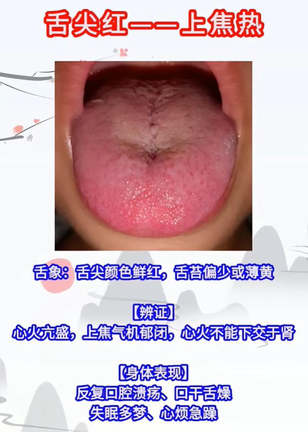 舌诊看懂上中下三焦！舌尖、舌中、舌根分别对应哪些问题？