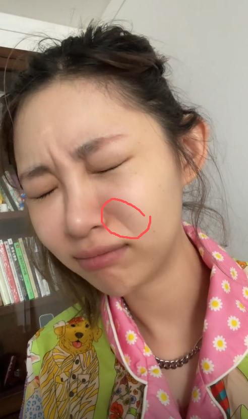 痞幼不满法令纹，大方承认医美，声称不是因为焦虑？

近日，顶流网红痞幼因在短视频