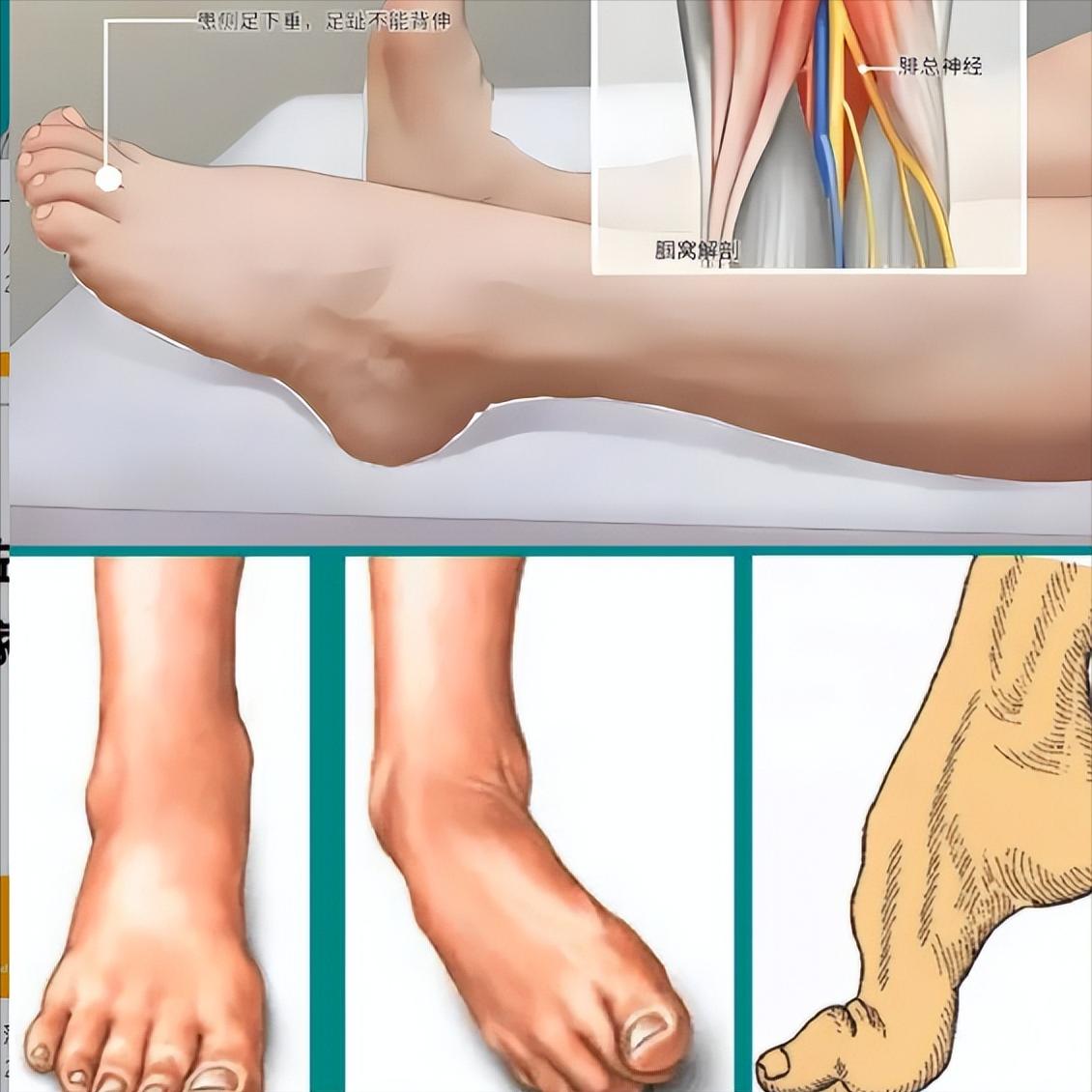 偏瘫练走路，脚上的问题别大意！一个足托能解决这么多事，很多人不知道


足托到底