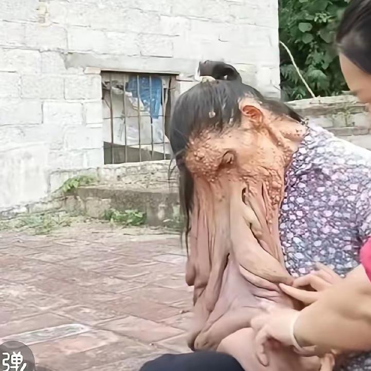 你能想象一个人脸上挂着二十来斤的肉瘤生活是怎样的吗？这个可怜的女人陆海妹，正被这