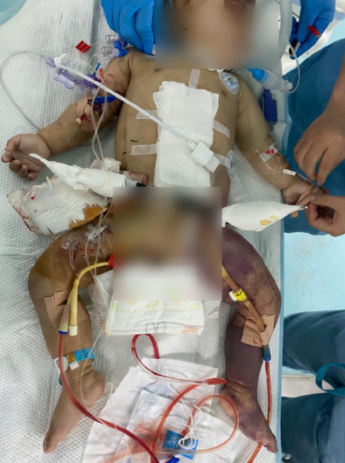 【3人骑电动车出车祸1岁宝宝截肢】1岁宝宝在妈妈后背被撞截肢 从浙江大学医学院附