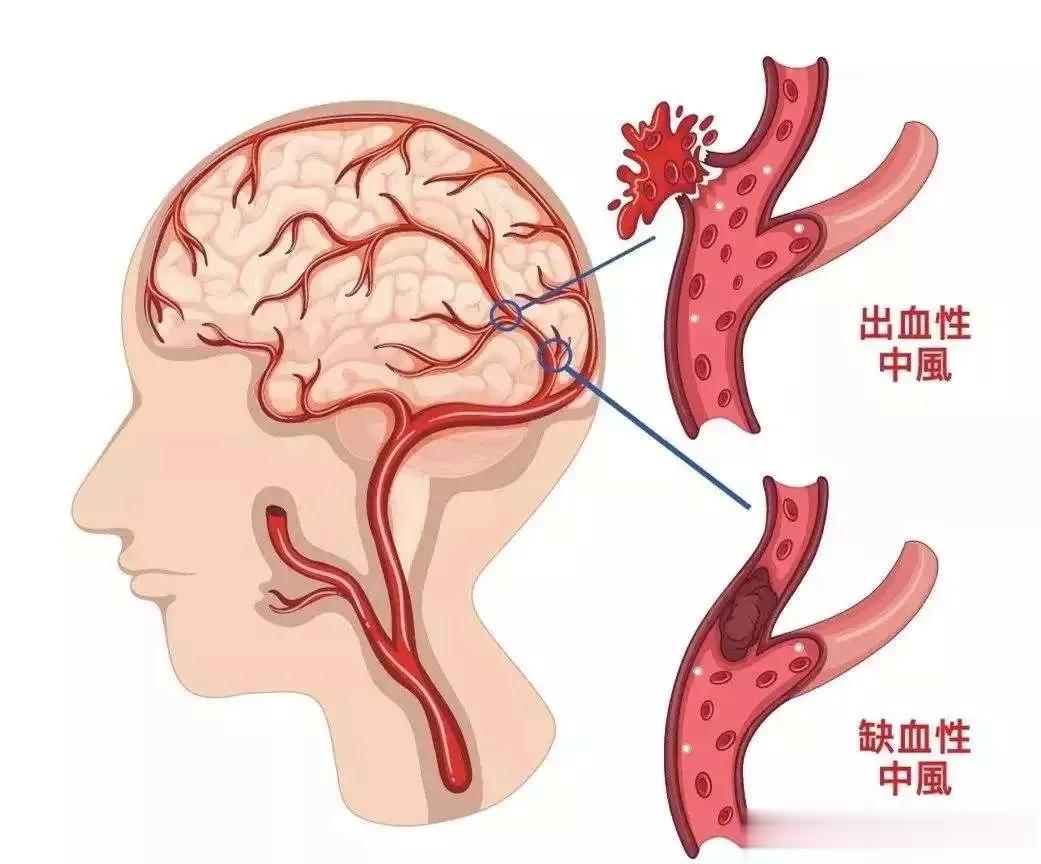 脑梗发生之前，身体会出现这3个征兆，要引起重视了1、哈欠不断打哈欠大脑缺氧的表现