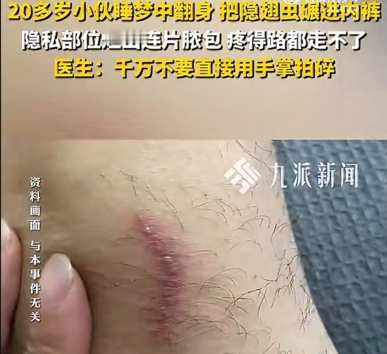 浙江台州，小陈夜里没关窗，隐翅虫钻进被窝。他睡梦中无意识翻身，直接把虫子碾进了内