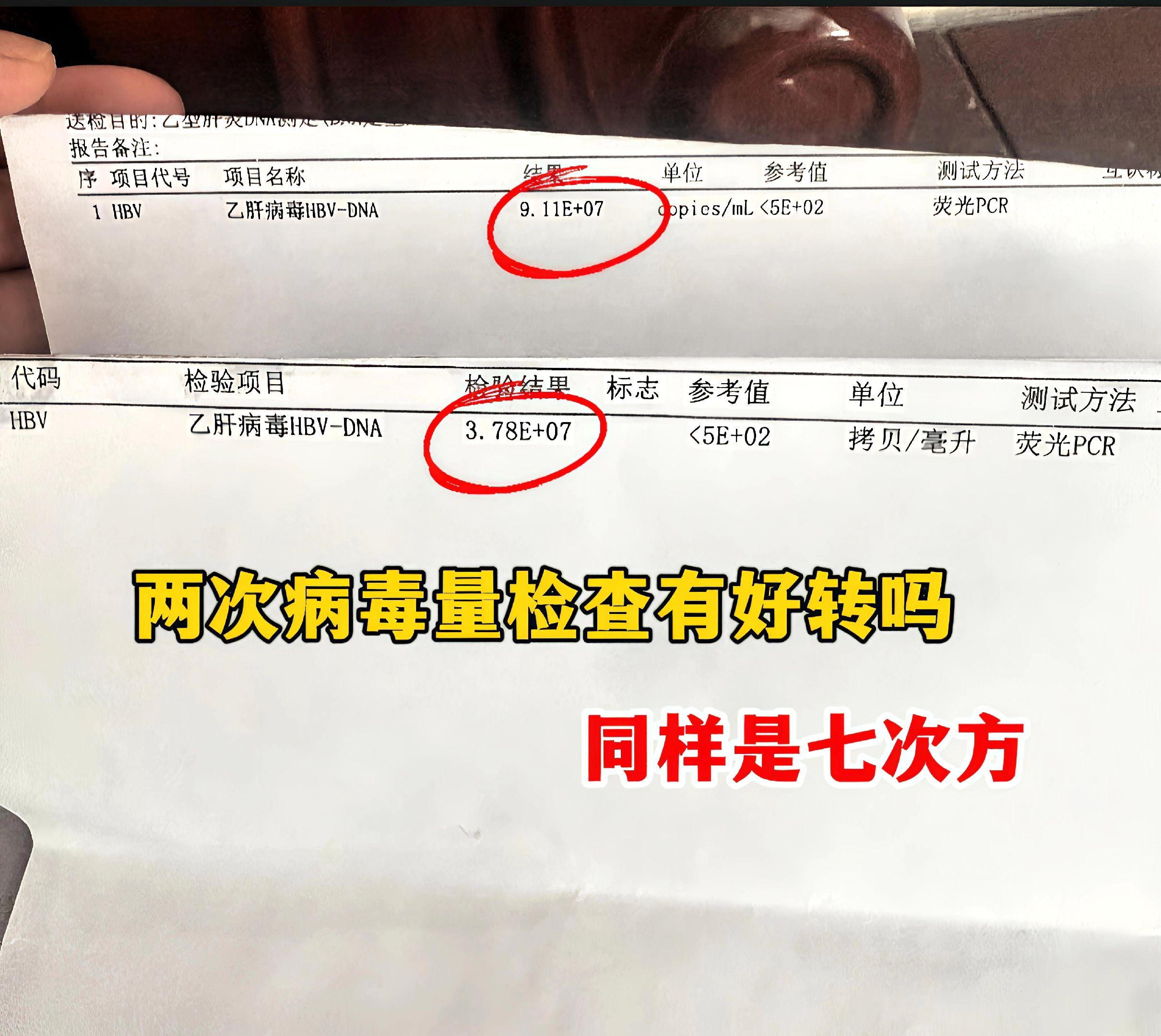之前查出乙肝的小伙子来复查，病毒量从原来的9.11E+07降到了3.7...