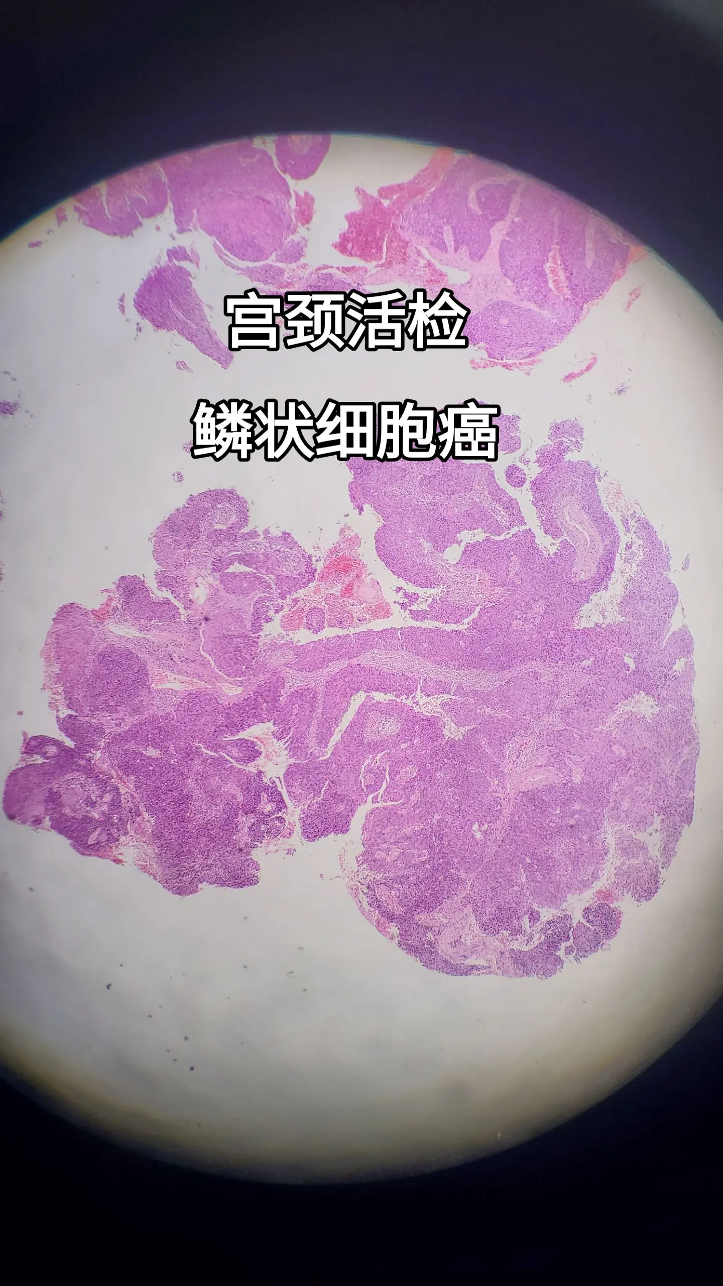 宫颈鳞状细胞癌