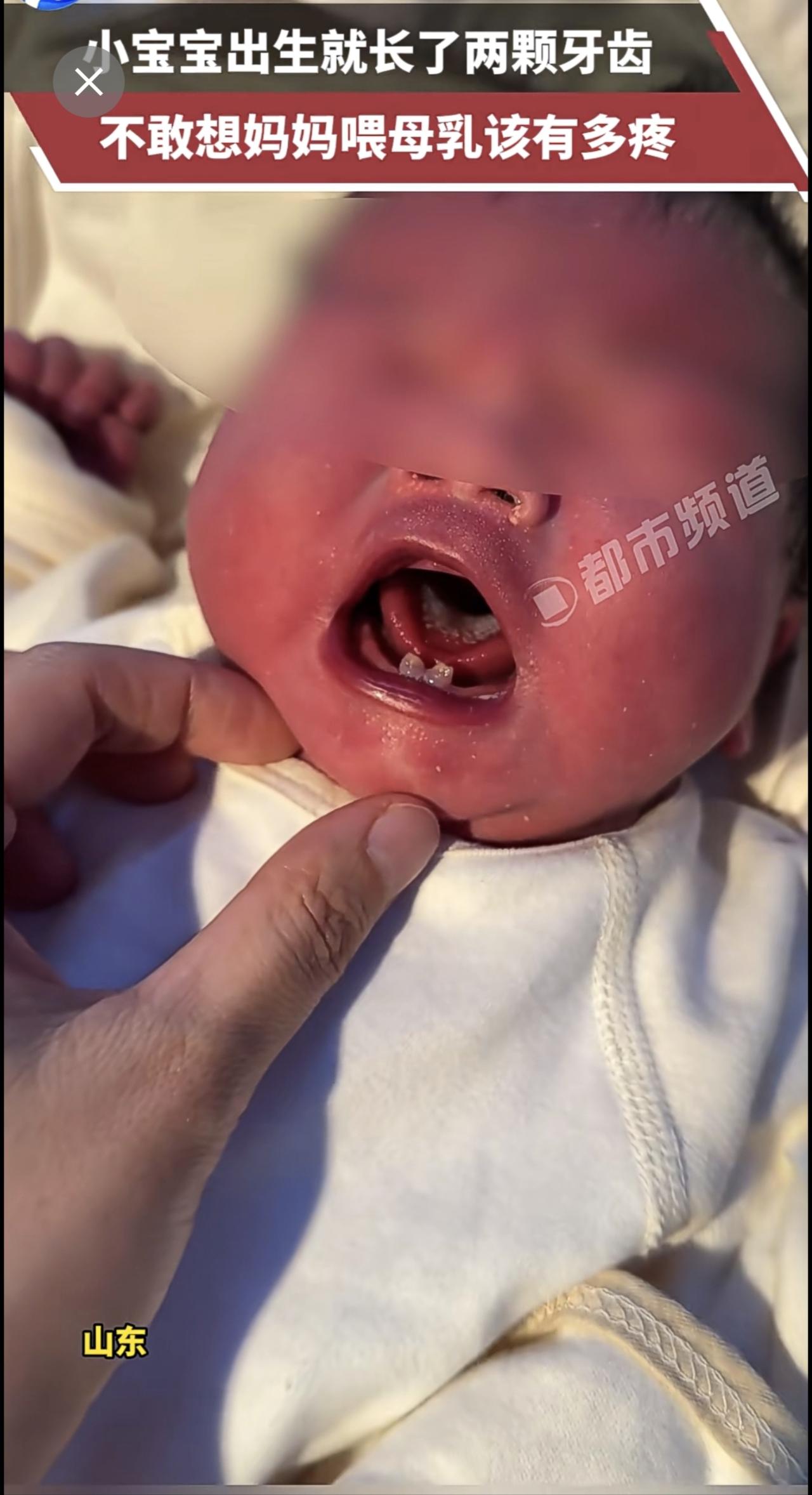 小宝宝出生就长了两颗牙齿，不敢想妈妈喂母乳该有多疼 。