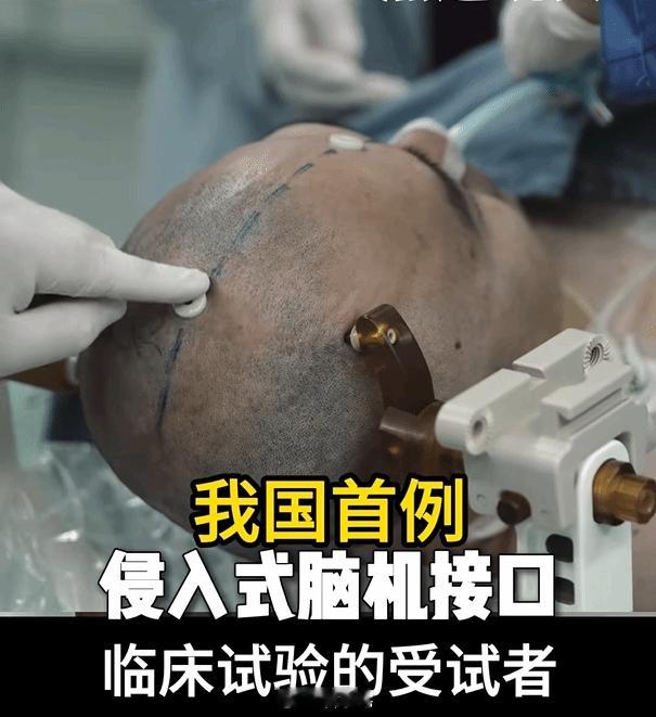 我国成功完成首例侵入式脑机接口手术 了，能用意念玩游戏！ ​​​