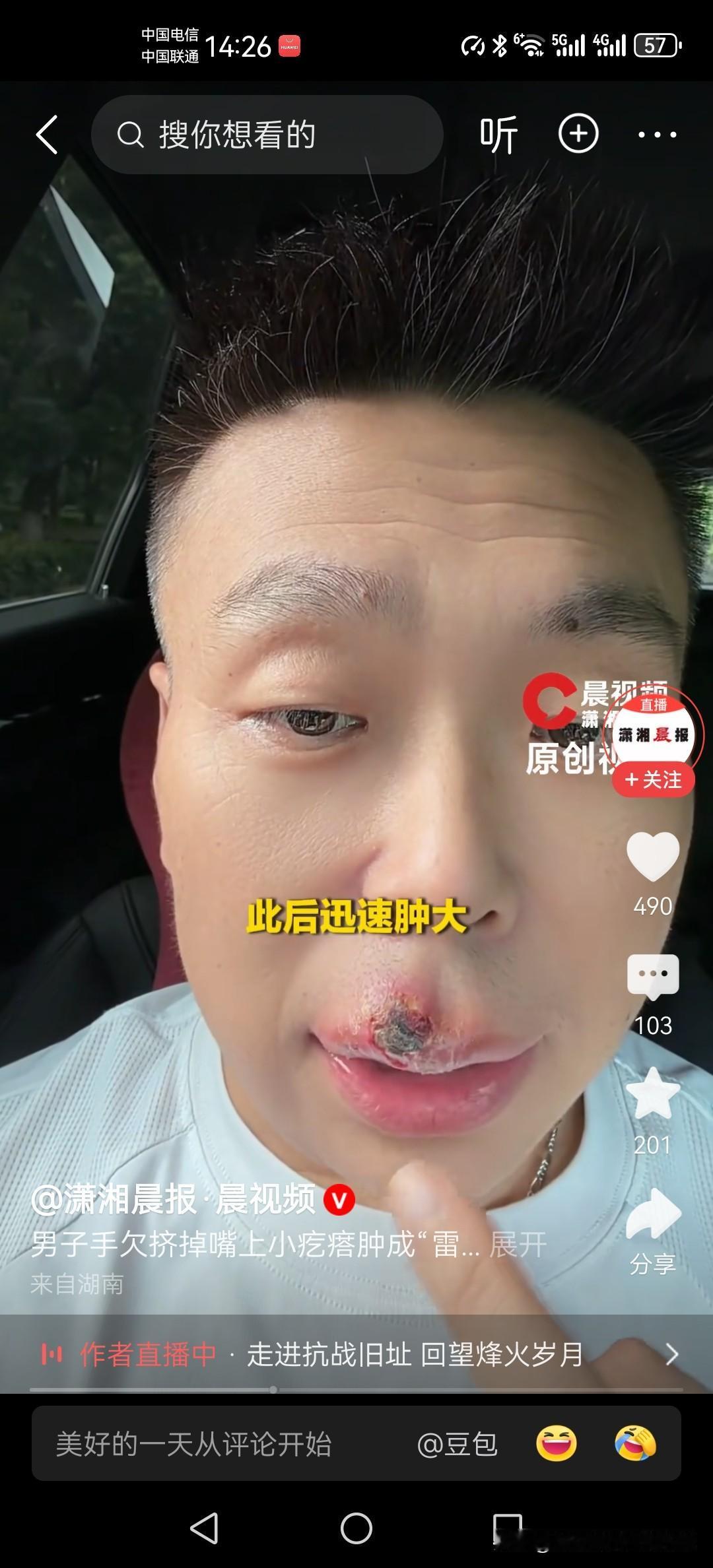 就挤了嘴上一个小疙瘩！男子脸肿成“雷震子”，流脓发烧差点闯大祸！
 
生活里不少