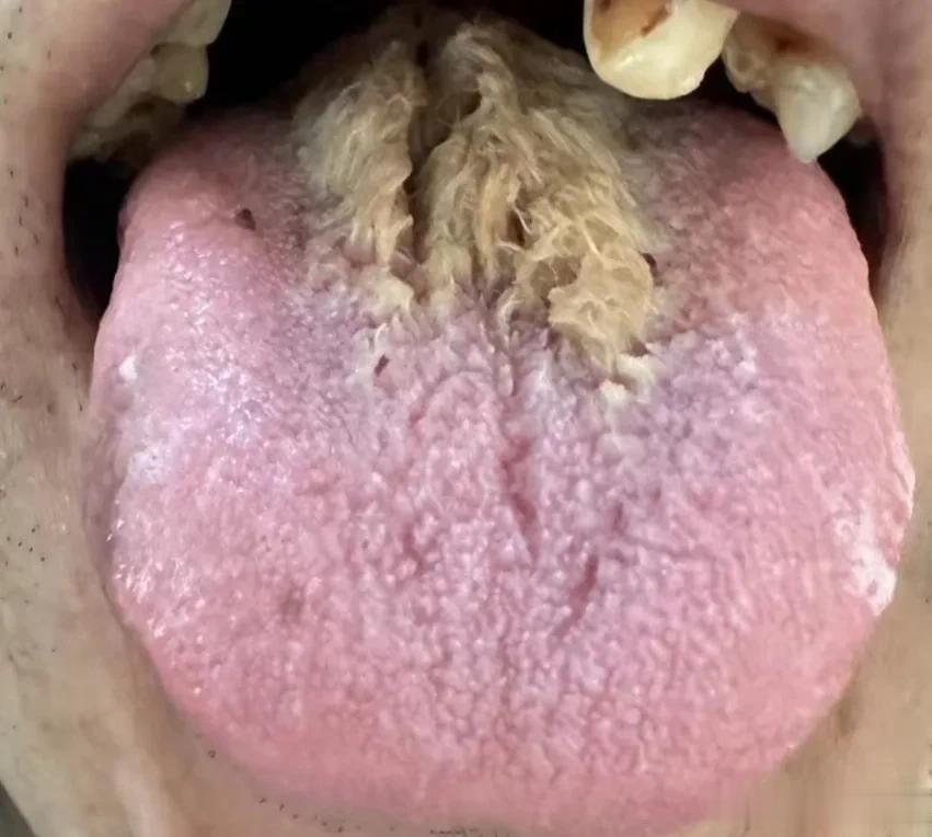 有朋友在群里发的舌苔，有知道怎么回事的吗？
在线求教。
看看就可，请勿转走。